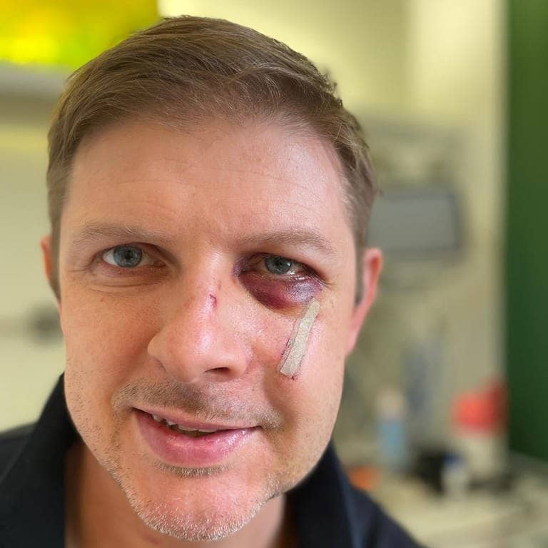 Matthias Ecke, der SPD-Politker ist und angegriffen wurde, lächelt mit einem blauen Auge in die Kamera.