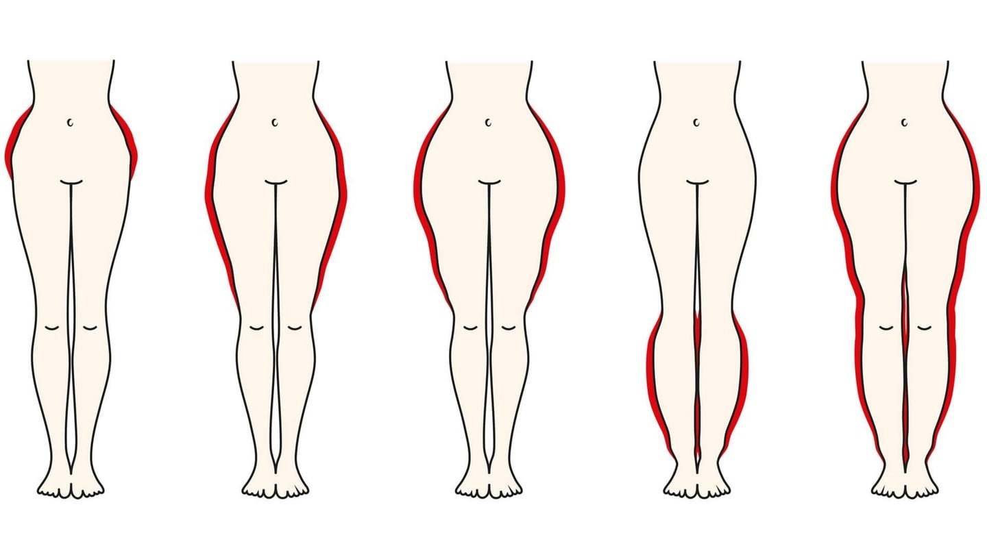 Foto: Fotolia © vanillya Ein Lipödem kann sich an verschiedenen Körperstellen bilden (Foto: Fotolia © vanillya)