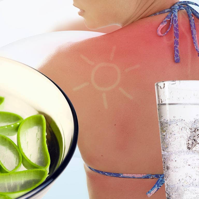 Tipps gegen Sonnenbrand – das hilft (Foto: IMAGO, agefotostock, Science Photo Library, Shotshop)