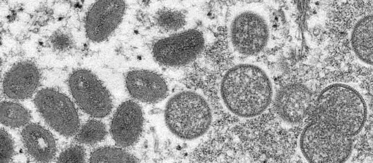 Diese elektronenmikroskopische Aufnahme aus dem Jahr 2003, die von den Centers for Disease Control and Prevention zur Verfügung gestellt wurde, zeigt reife, ovale Affenpockenviren (l) und kugelförmige unreife Virionen (r), die aus einer menschlichen Hautprobe im Zusammenhang mit dem Präriehundeausbruch von 2003 stammt.  (Foto: dpa Bildfunk, picture alliance/dpa/Russell Regner/CDC/AP | Cynthia S. Goldsmith)