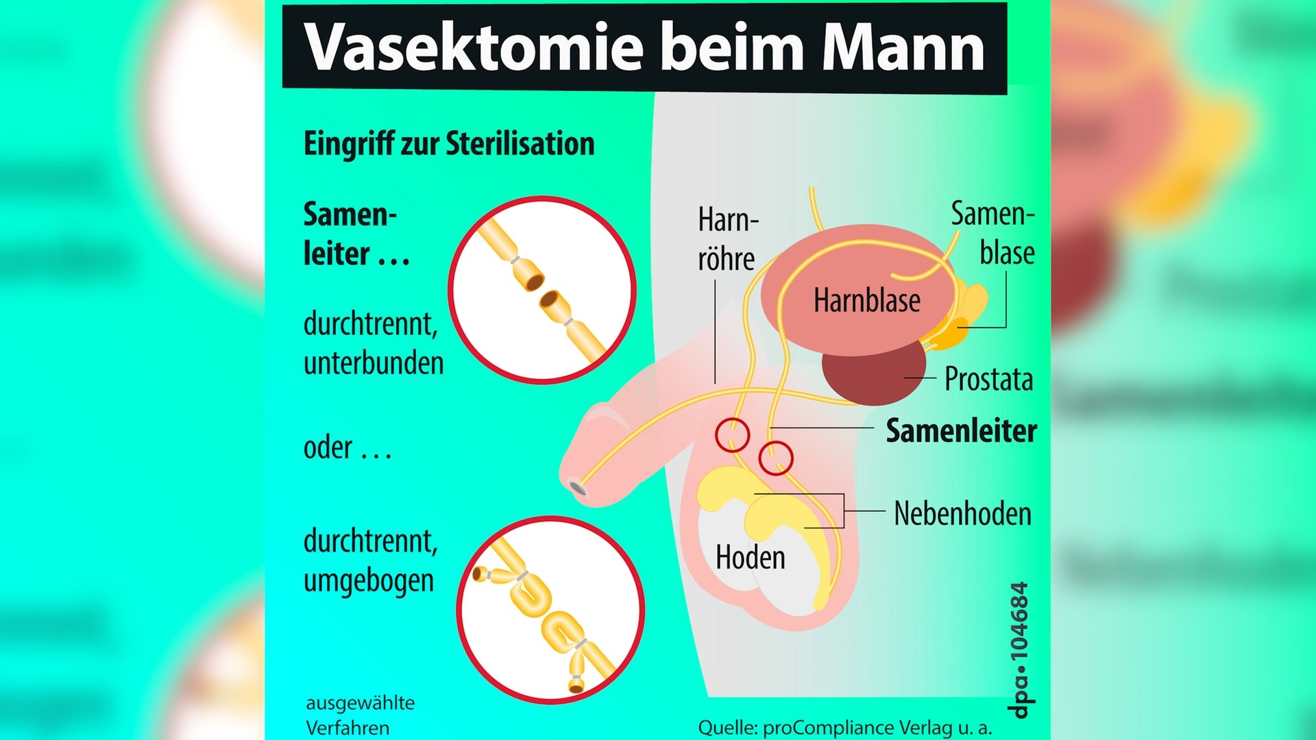 Eine Grafik einer Vasektomie. (Foto: picture-alliance / Reportdienste, picture alliance/dpa/dpa Grafik | dpa-infografik GmbH|Monatge: SWR3)