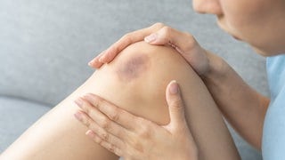 Nahaufnahme eines blauen Flecks auf dem Knie einer Frau. Symbolbild für Artikel zu Hämatomen, die ohne Grund auftreten. Zu deren Ursachen und Möglichkeiten zur Behandlung.