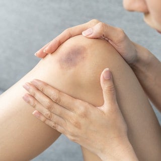 Nahaufnahme eines blauen Flecks auf dem Knie einer Frau. Symbolbild für Artikel zu Hämatomen, die ohne Grund auftreten. Zu deren Ursachen und Möglichkeiten zur Behandlung.