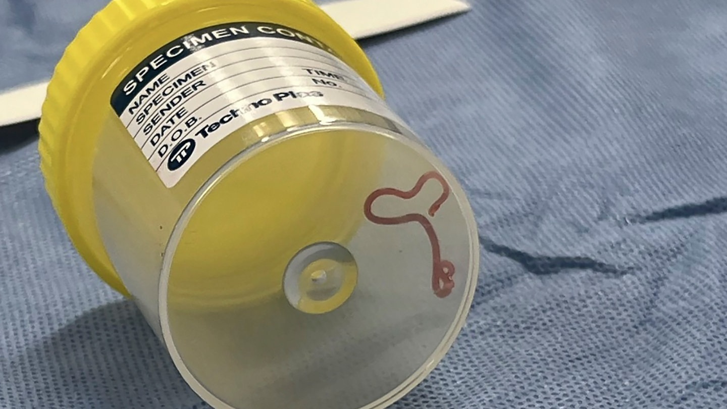 Foto: dpa Bildfunk, picture alliance/dpa/Canberra Health Services/AP | - Dieses undatierte Foto, das von Canberra Health Services zur Verfügung gestellt wurde, zeigt einen Rundwurm in einem Probengefäß in einem Krankenhaus in Canberra. In einem Krankenhaus in Canberra haben Ärzte einen lebendigen, acht Zentimeter langen Rundwurm aus dem Gehirn einer 64-jährigen Frau entfernt. (Foto: dpa Bildfunk, picture alliance/dpa/Canberra Health Services/AP | -)