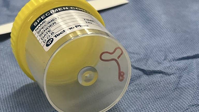 Dieses undatierte Foto, das von Canberra Health Services zur Verfügung gestellt wurde, zeigt einen Rundwurm in einem Probengefäß in einem Krankenhaus in Canberra. In einem Krankenhaus in Canberra haben Ärzte einen lebendigen, acht Zentimeter langen Rundwurm aus dem Gehirn einer 64-jährigen Frau entfernt.